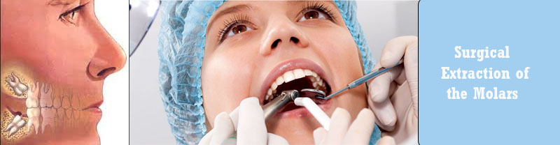 Surgical Extraction of the Molars